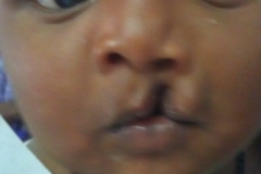 Cleft-lip-Before